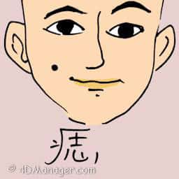 痣 mole
