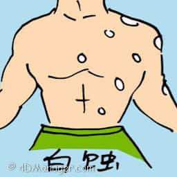 白蚀 vitiligo skin disease