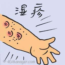 湿疹 eczema