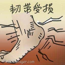 韧带受损 ligament injury
