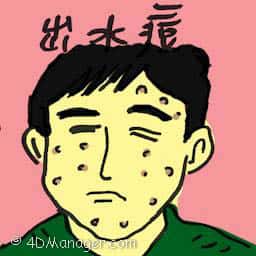 出水痘 chicken pox
