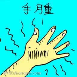 手肿 swollen hand