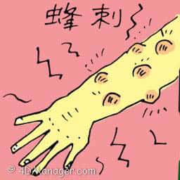蜂刺 stung by bee