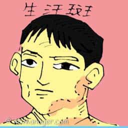 生汗斑 sweating