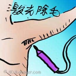 激光除毛 laser hair removal