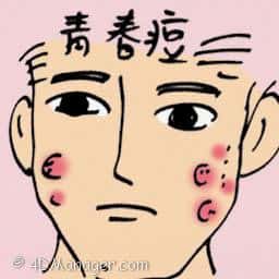 青春痘 acne