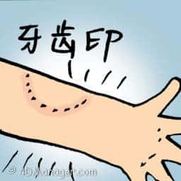牙齿印 teeth mark